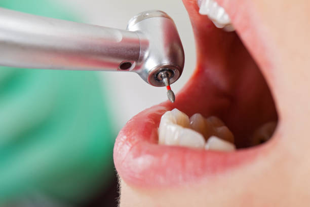 Best Emergency Root Canal Treatment in Woodworth, OH